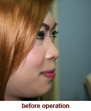 plastic_surgery_augmentation_rhinoplasty